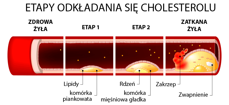 Odkładanie się cholesterolu